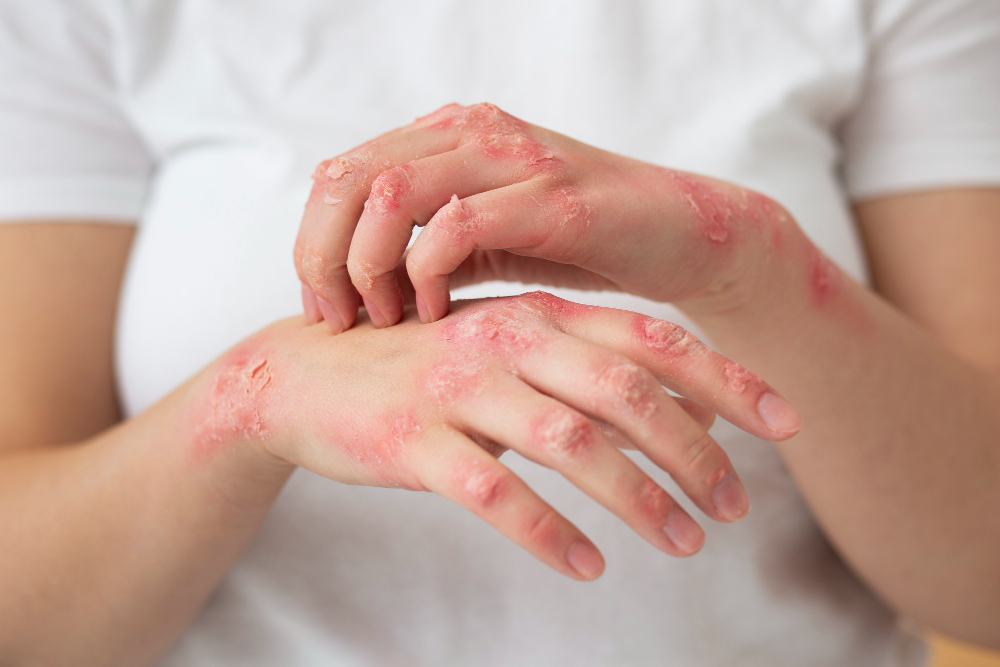 Isavuconazol (Cresemba®): Avanços no Tratamento de Infecções Fúngicas Graves e Direitos dos Pacientes